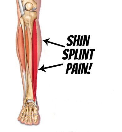 Shin splints clip.