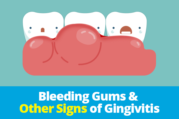 Bleeding gums other.