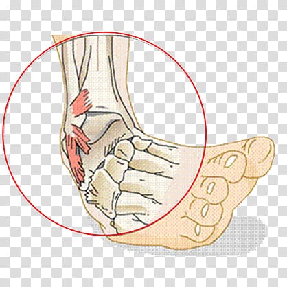 Sprained ankle Ligament Injury, others transparent