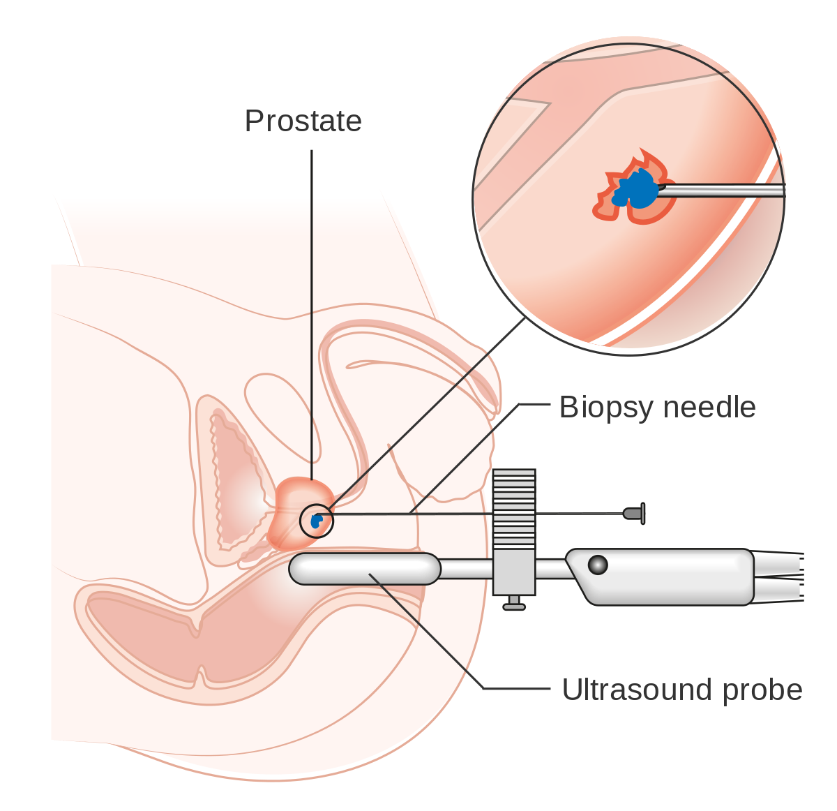Needle clipart biopsy, Needle biopsy Transparent FREE for