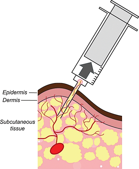 Schematic representation of needle aspiration biopsy