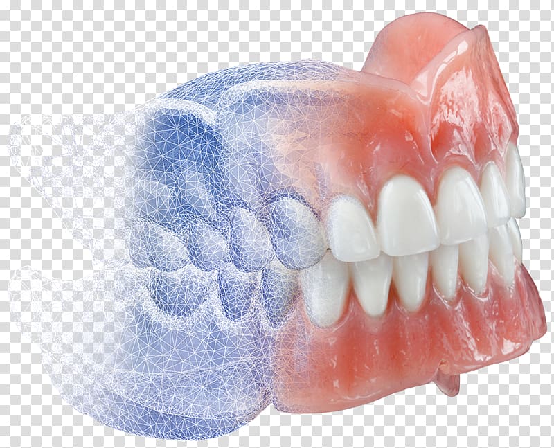 Dentures burdette dental.
