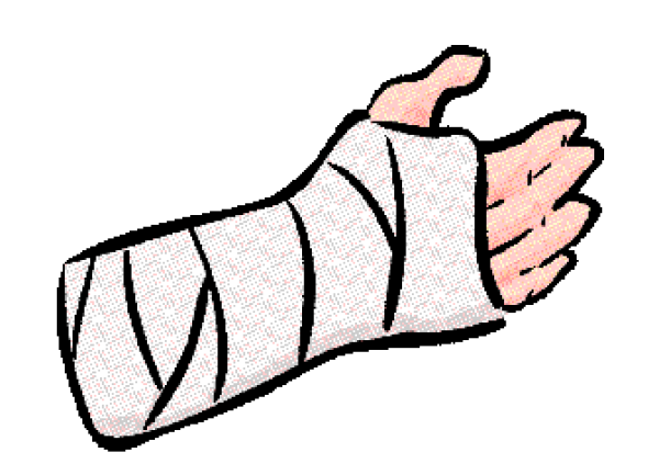 Clipart Arm Cast and other clipart images on Cliparts pub â„¢.